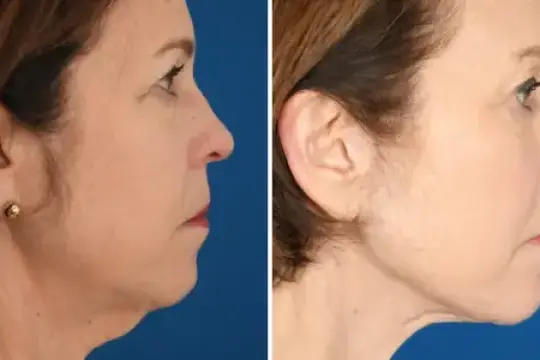 我65岁花了3.3万美元做整形手术，这改变了我的事业和自信心